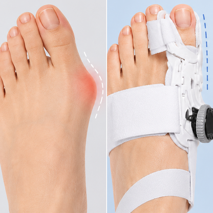 LIMETOW® Bunion Corrector