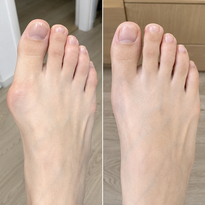 LIMETOW® Bunion Corrector